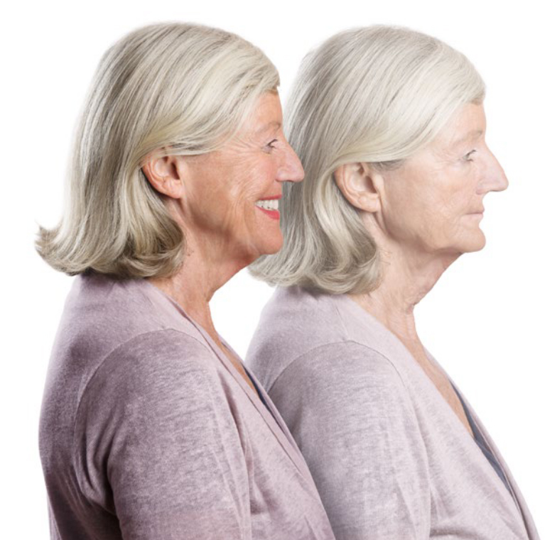 All-on-4 in Verbindung mit Zygoma-Implantaten löst das Problem: Je weiter der Knochen-Abbau fortgeschritten ist, desto eingefallener wirkt der Oberkiefer. Patienten erscheinen älter als sie sind.